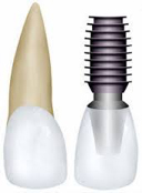 implants